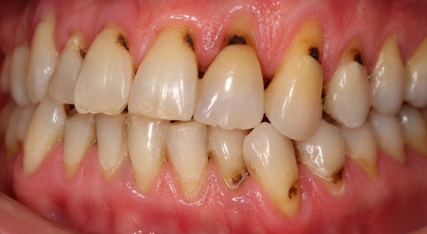snus-new-teeth-dark-620x340.jpg