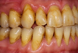 snus-new-teeth-yellow-320x220.jpg snus-new-teeth-yellow-320x220.jpg